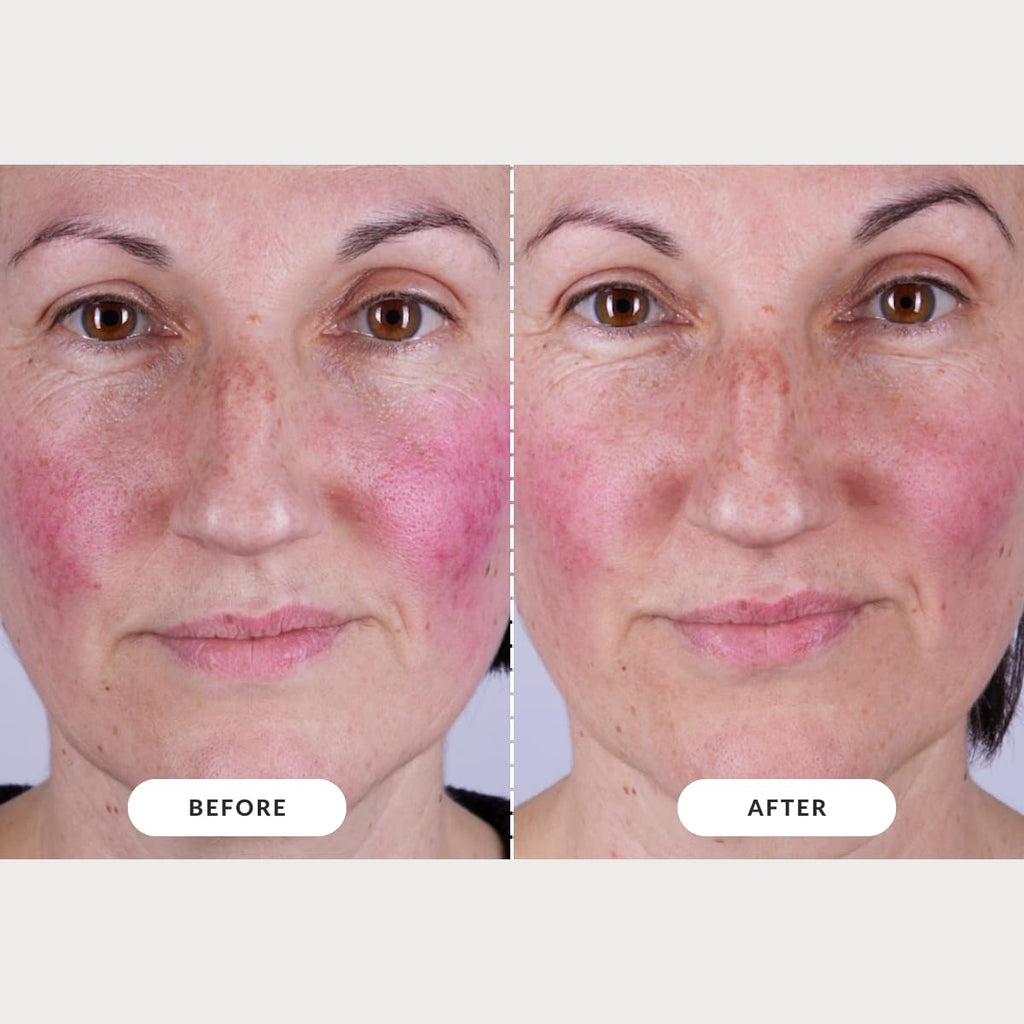 Currentbody Skin LED Light Therapy Mask: Series 2