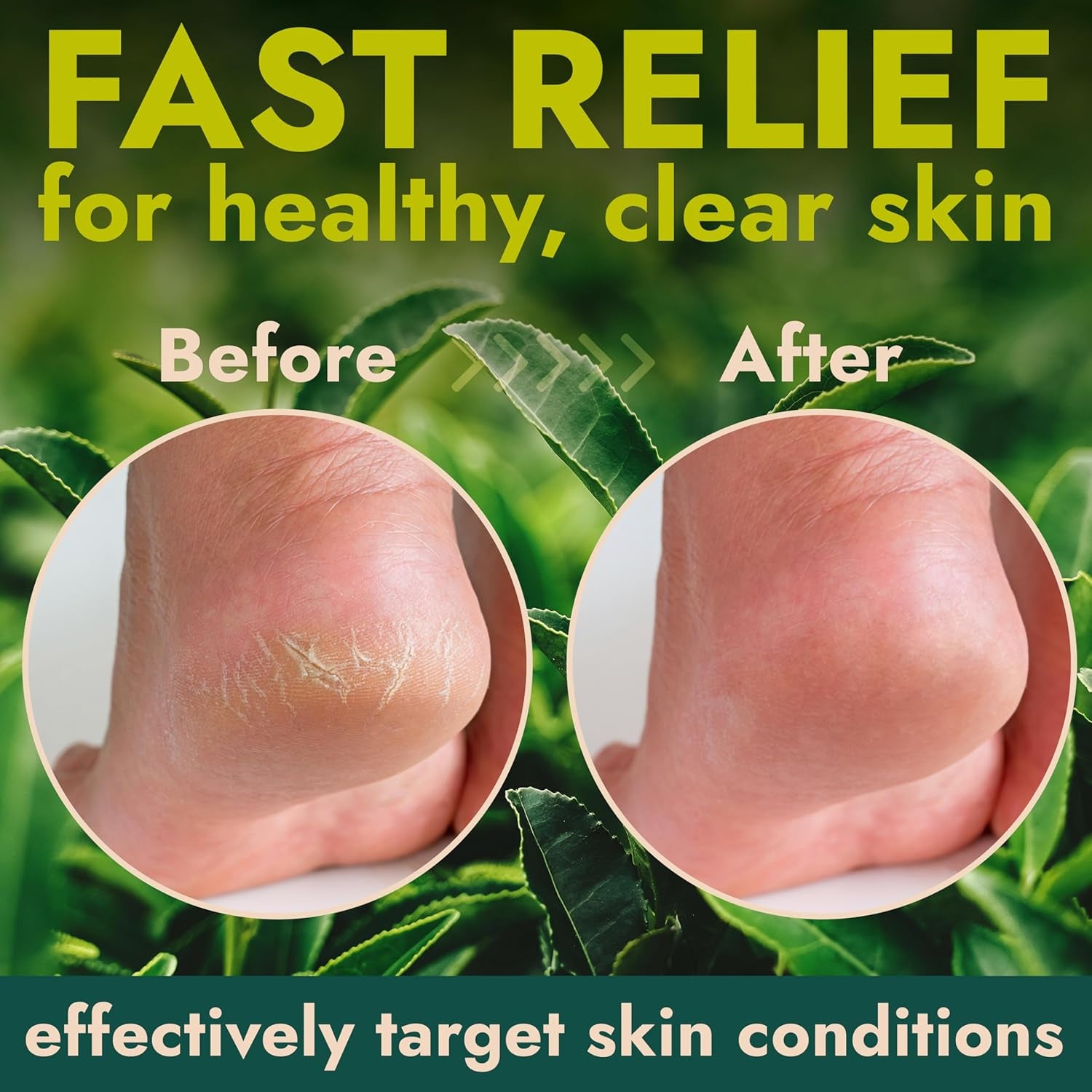 Callus Remover for Feet | Extra Strength Callus Remover Gel for Feet with Tea Tree Oil | Professional-Grade Pedicure Treatment | 50 Applications per Bottle, Includes 3 Pumice Stones | 14 Fl Oz