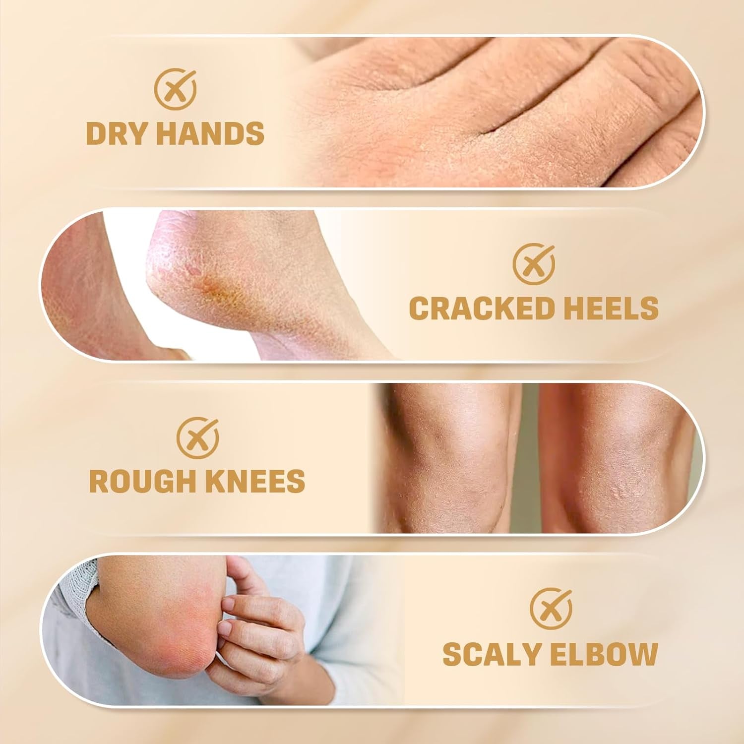 60% Urea Cream with 2% Salicylic Acid, Urea Cream 60 Percent for Feet & Hands- Maximum Strength Moisturizer for Rough, Dry, Thick & Cracked Skin, Callus Remover, Deep Hydration, 150G